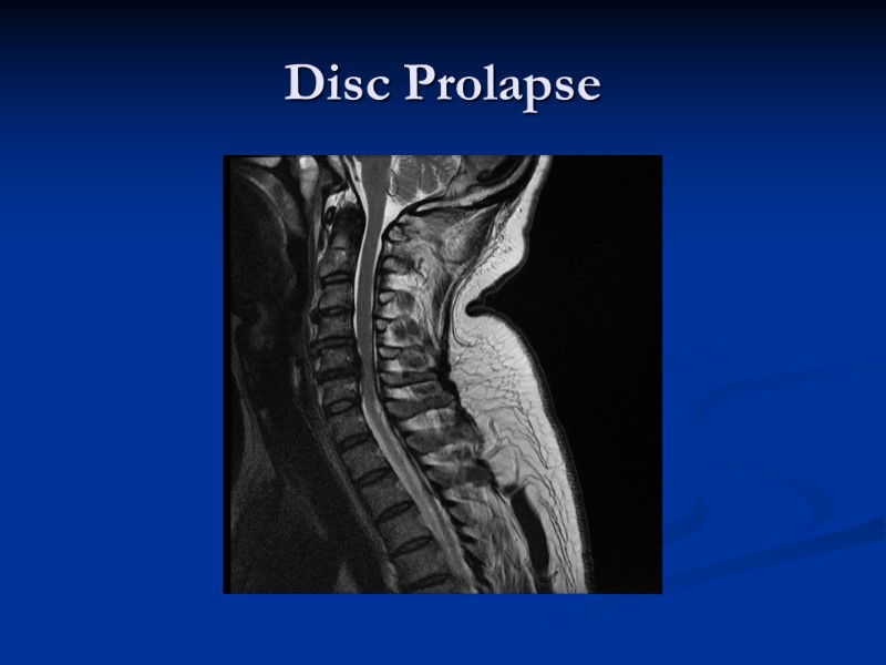 Disc Prolapse